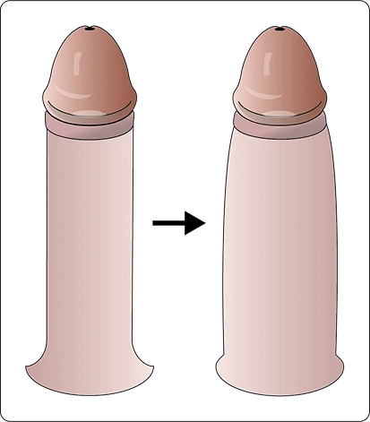 Ilustração comparativa do engrossamento peniano — antes e depois do procedimento